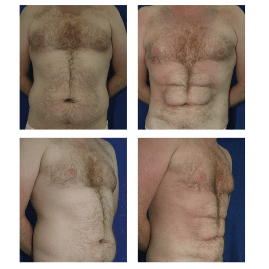 lipo before and after